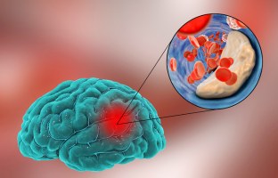 stroke and cerebrovascular
